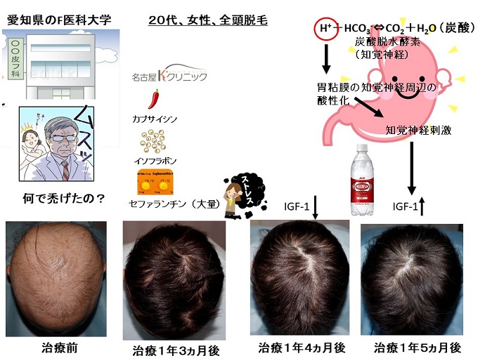 円形脱毛症　病院
